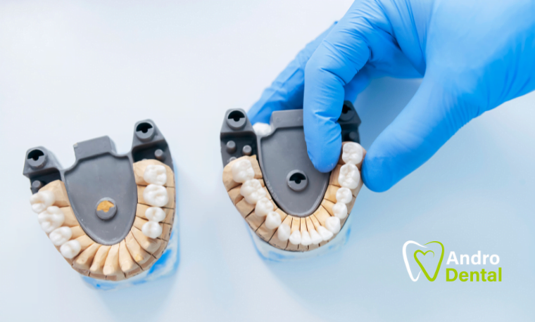 andro-dental-mennyi-ido-alatt-keszul-el-a-fogpotlas